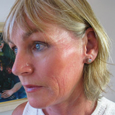 Auringonpolttama iho Dermaroller-hoidon j&auml;lkeen