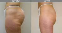VelaShape