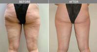 VelaShape