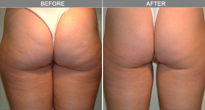 VelaShape